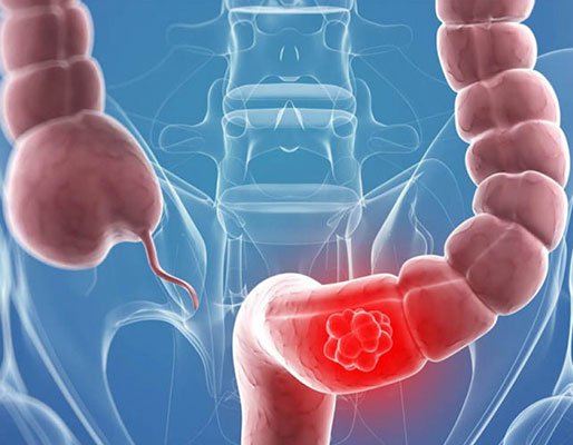 Diagnostico-de-cancer-de-colon-1