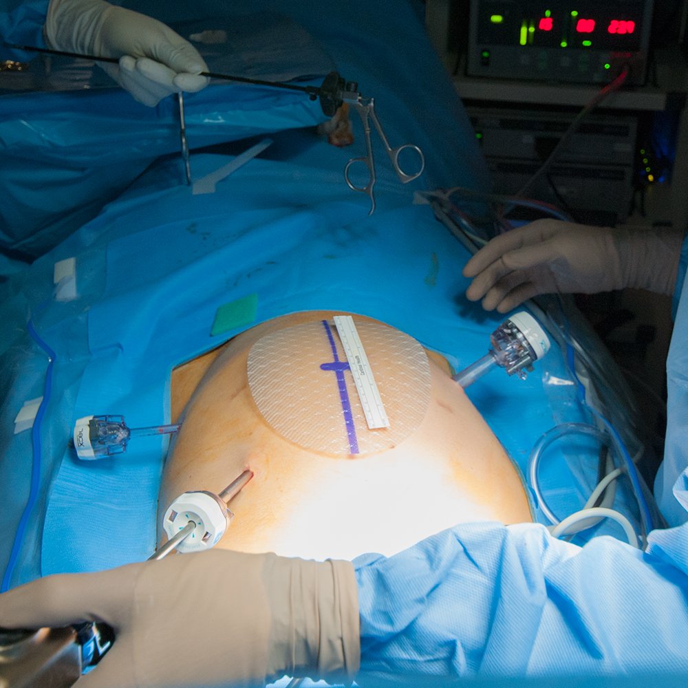 Hernia Surgery_0