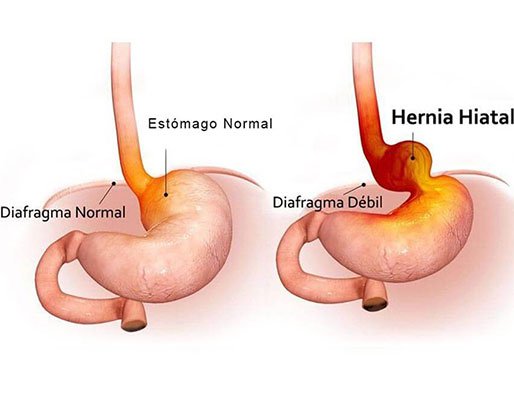 La-hernia-de-hiato