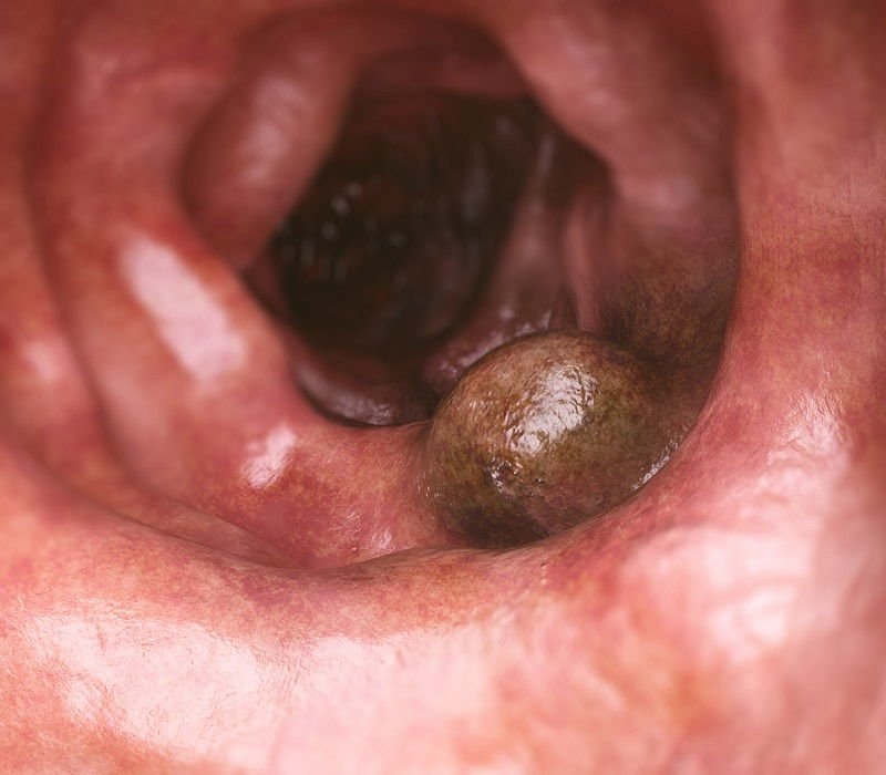 cancer-colon-primer-plano