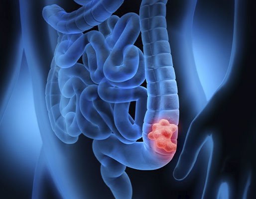 cancer-de-colon-1