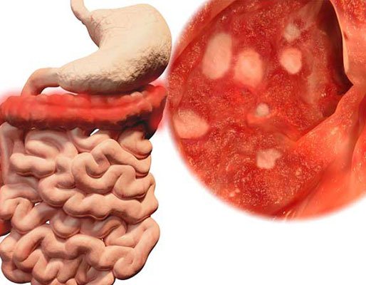 sindrome-intestino