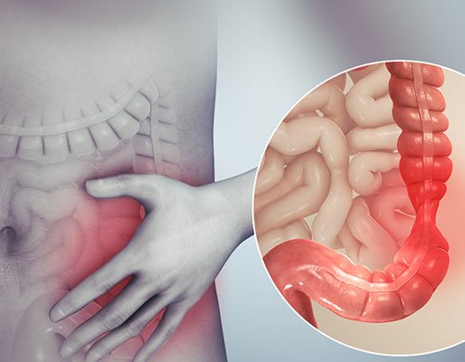 sindrome-intestino2